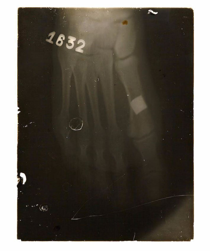 Рентгеновский снимок ступни Эрнеста Хемингуэя