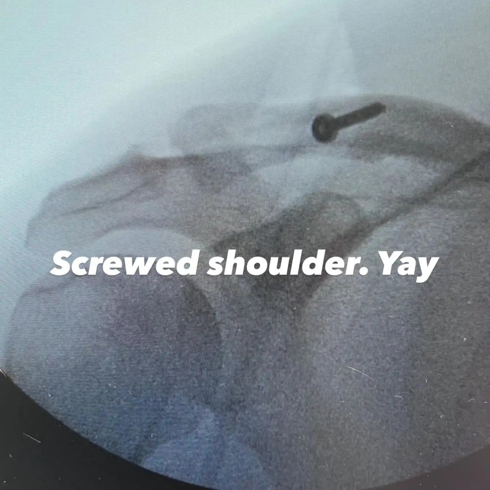 Рентген Ченнинга Татума после операции / Фото: соцсети Ченнинга Татума