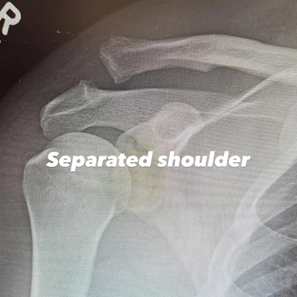 Рентген Ченнинга Татума до операции / Фото: соцсети Ченнинга Татума